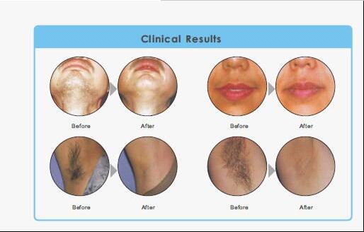 Permanent SHR Hair Removal Machine Opt Ipl Technique For Beauty Spa