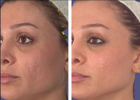 Highly Effective Oxygen Jet Peel Machine Skin Beauty Machine With Ozone Output