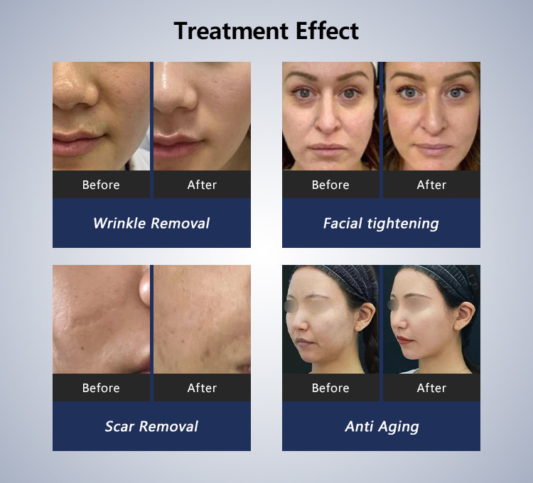 Medical Grade Skin Remodeling System White RF Microneedling Machine For Collagen Induction
