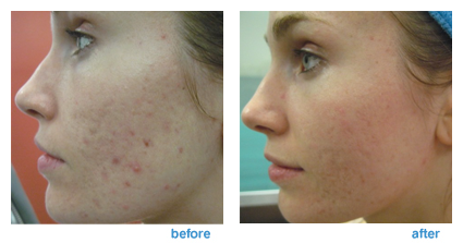 Tightening Skin Fractional CO2 Laser Beauty Machine For Acne Pigment Scar Removal
