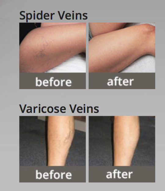 high power 980nm diode laser Vascular Removal
