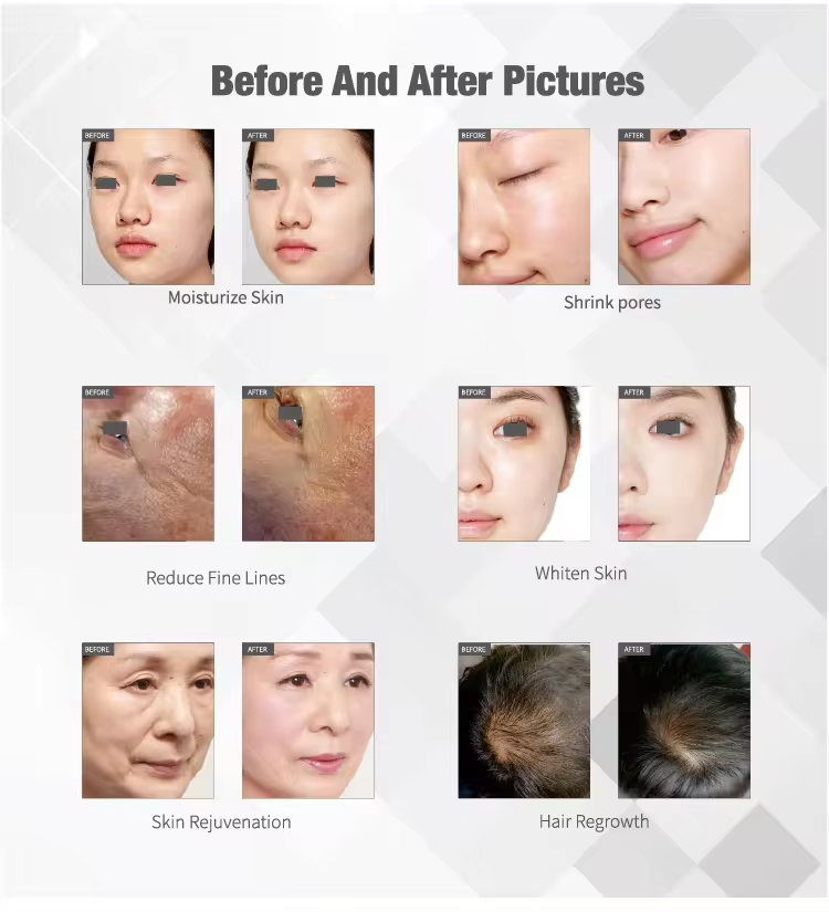 Needless RF Meso Machine Anti Aging Mesotherapy Machine For Face