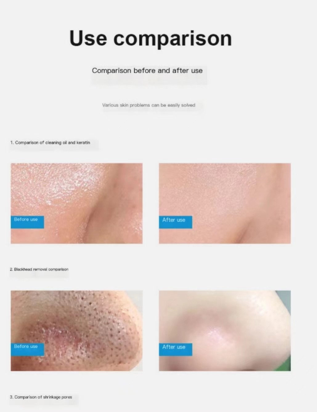 Blackhead Remover Hydra Beauty Machine Facial Skin Aqua Deep Cleaning 14 In 1