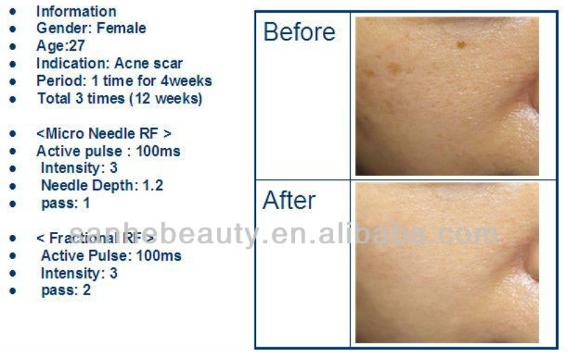 skin lifting machine fractional micro needles RF