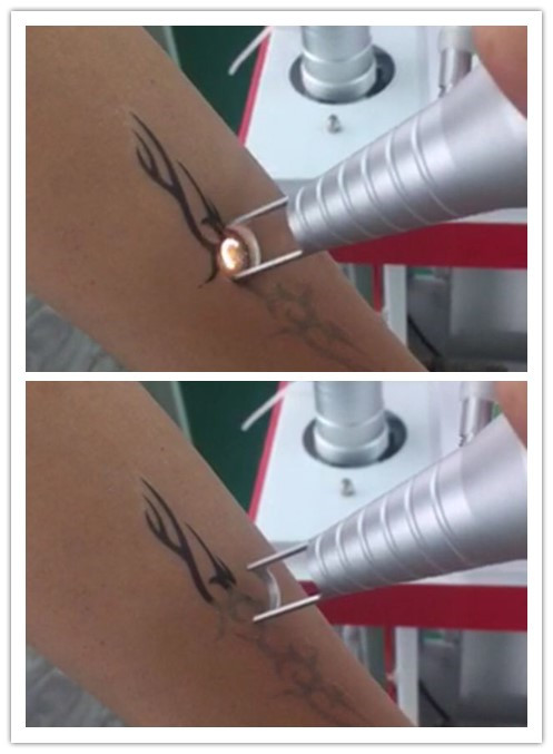 Vertical 1064nm 532nm Q-Switched ND YAG New Laser tattoo removal machine