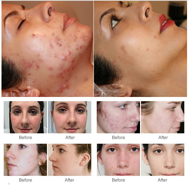 Hot Selling 8 Head Facial Beauty Machines Professional Portable Oxygen Facial Machine