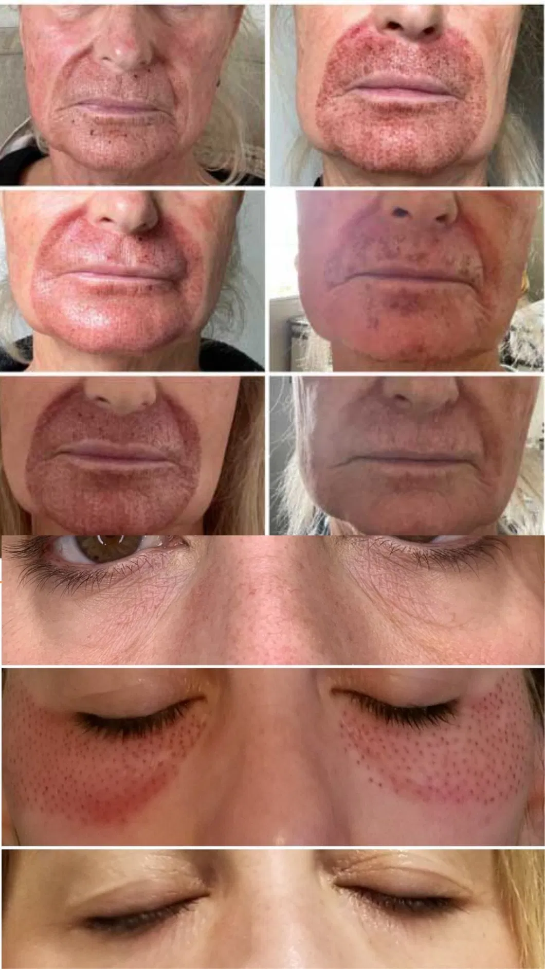 10 in 1 Cold and Warm Plasma Skin Rejuvenation Improve Fine Lines Jet Face Body Care Wrinkle Removal Plasma Machine