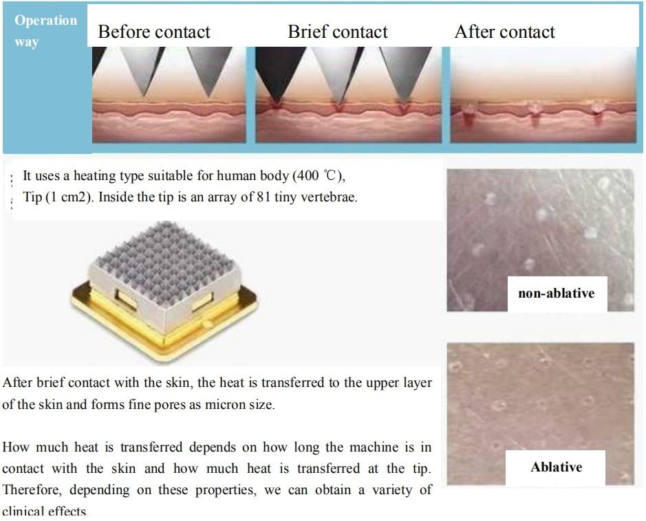 50000 Shots RF Microneedling Machine Pigment Removal CE ISO Approval