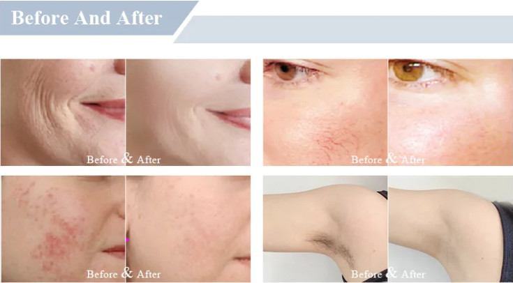 Multifunctional Ipl Opt Elight Hair Removal Skin Care Wrinkle Removal Machine
