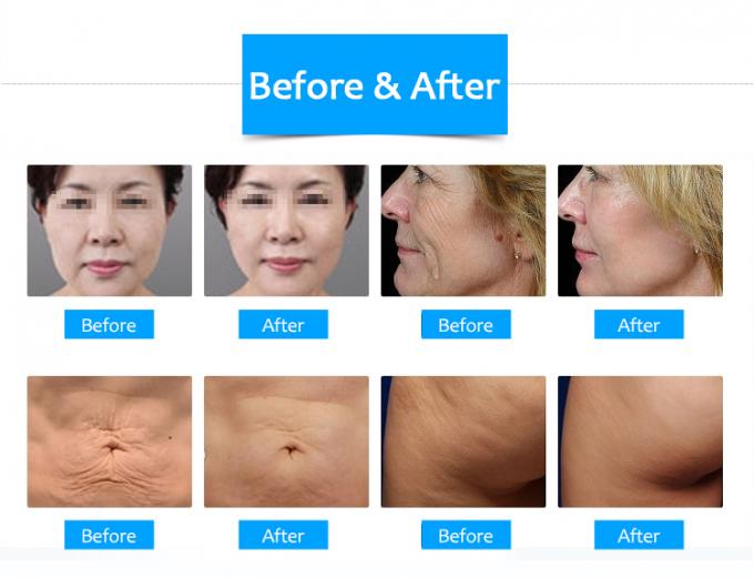 Honkon Rf Beauty Equipment Thermage Skin Improvement Anti Aging Beauty Salon Mchine 2