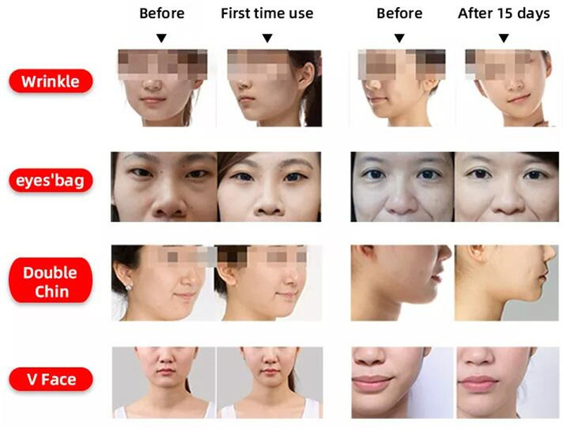 Mini Hifu Ems Vibration Beauty Device 4 Lines Facial Lifting Skin