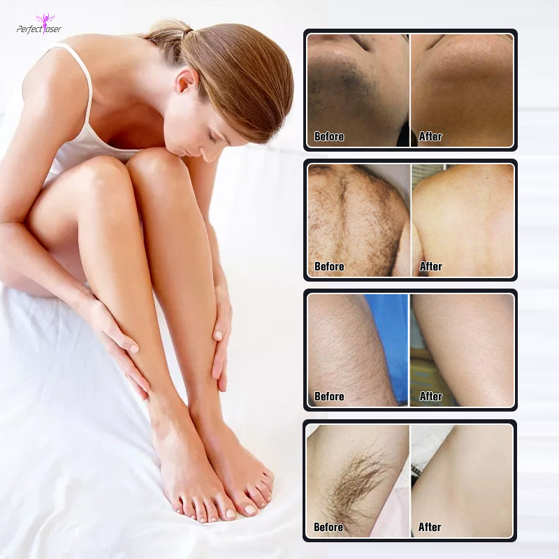 808nm Diode Ice Laser Machine Permanent For Hair Removal Skin Rejuvenation