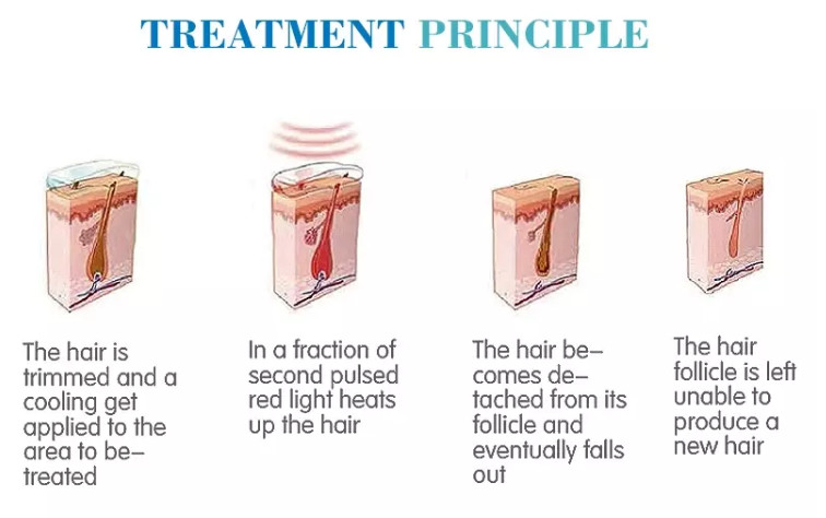 cooling gel laser hair removal 808 diode laser hair removal machine