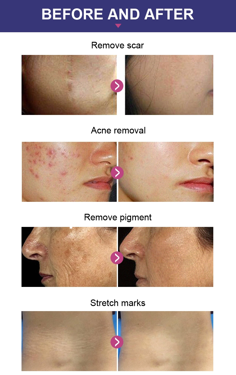 Gynecology CO2 Fractional Laser Machine For Vaginal Tightening