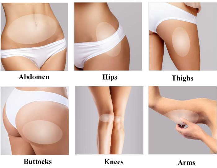 Skin Tightening Cellulite Treatment Machine 10 To 190mj Continuously Energy