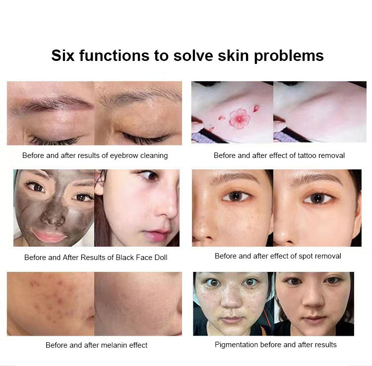 Gomecy Carbon Laser Peel Machine Whitening Face Ndyag Laser Machine For Beauty Care