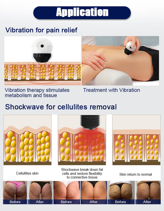 Eswt Shock Wave Therapy Machine For Erectile Dysfunction Treatment Pain Relief