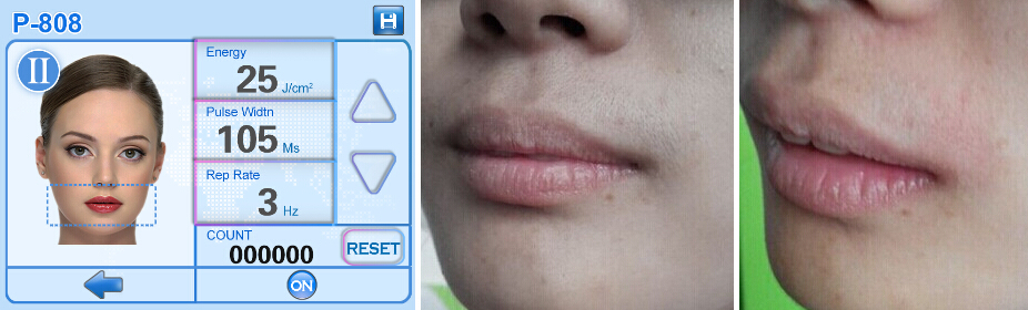 Diode Laser 808 Hair Removal/No Side Effect/ Painless USA 808 diode laser/808nm Diode Laser