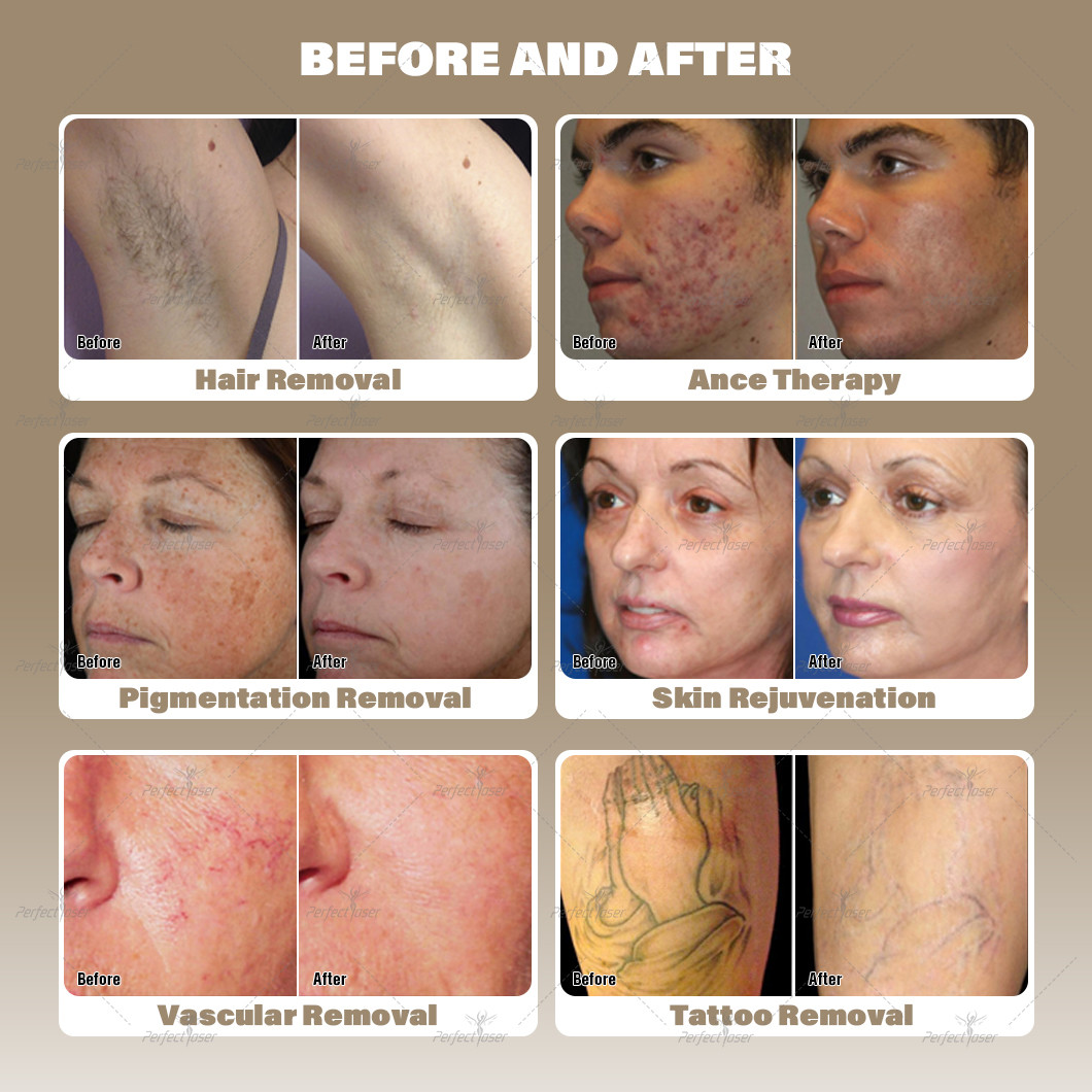 5 In 1 Laser Hair Tattoo Removal Treatment Multifuntional Cost Effective Nd Yag Picosecond