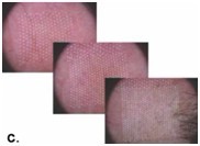 Radio Frequency Fractional CO2 Laser Machine Far-infrared For Syringoma Removal Harmless