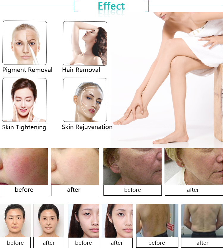 Skin Guardian!! IPL laser hair removal / IPL Skin Rejuvenation Machine Price / IPL machine price with CE