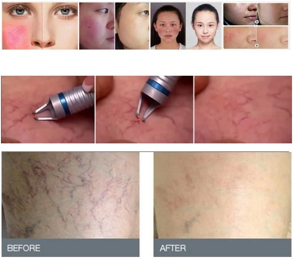 Powerful 30W diode laser red vascular removal 980nm machine