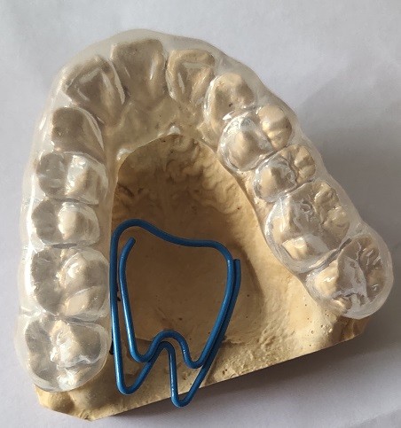Trushine Soft Comfortable Night Guard For Bruxism