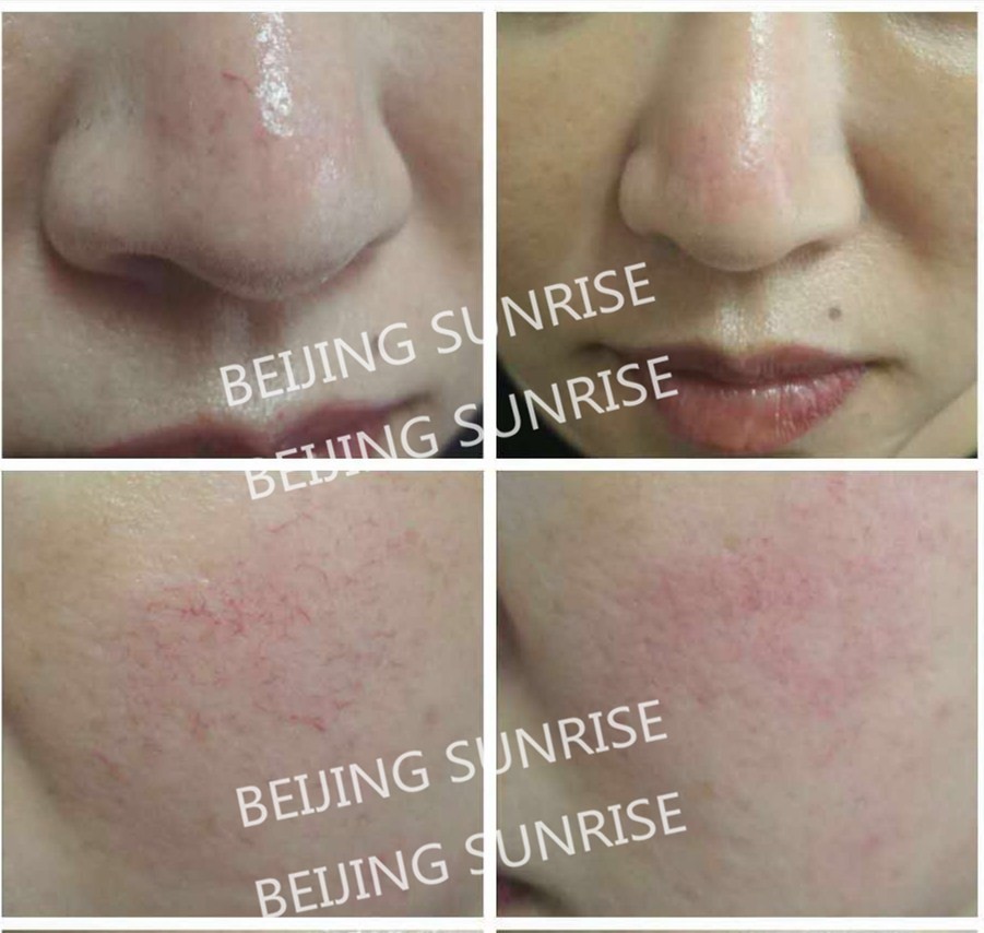 980nm beauty equipment vascular remover vascular cleaner spider veins removal