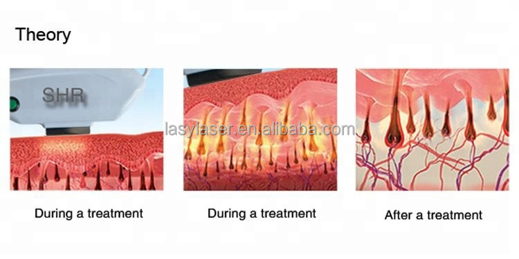 IPL SHR Lightsheer Diode Laser Hair Removal 50HZ Triple Wave
