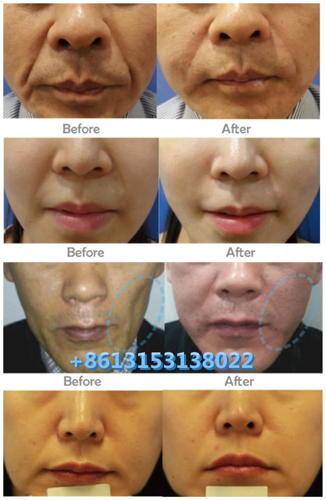 Dermal Hyaluronic Acid HA Filler Juvederm Voluma Ultra3 Ultra4