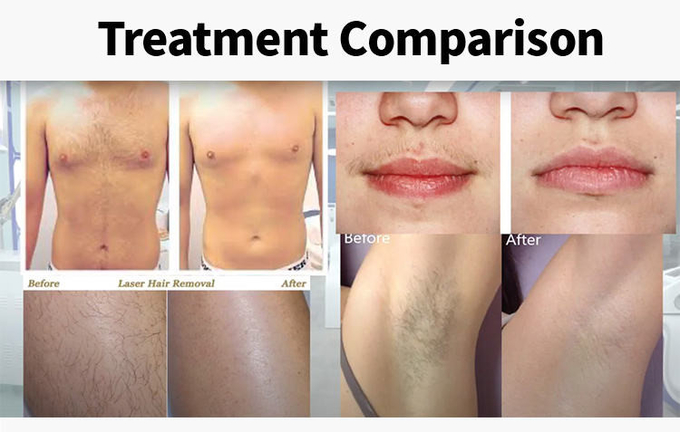 755nm 808nm 1064nm Diode Laser FDA Approved 808 Diode Laser Hair Removal
