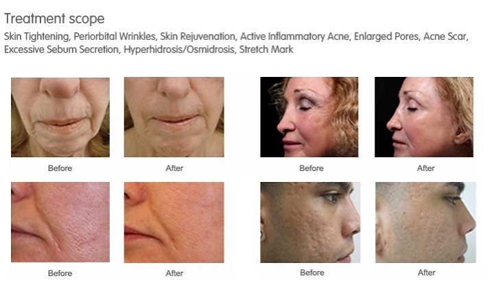 stretch mark removal rf fractional rf microneedle machine