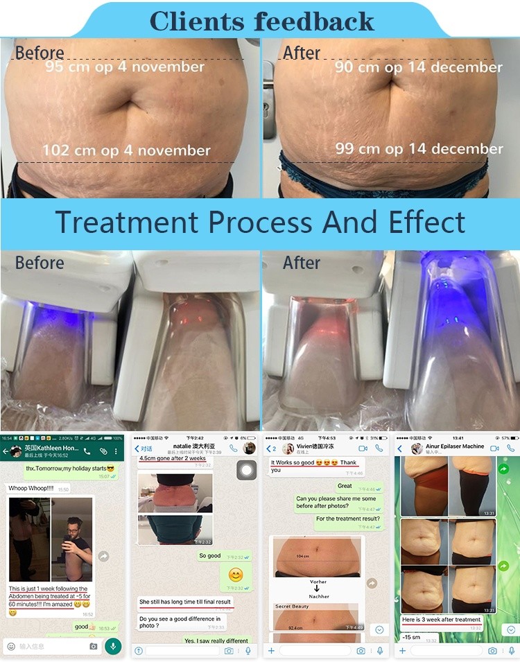 cryo lipo fat freezing machine vacuum slimming cryolipolysis machine