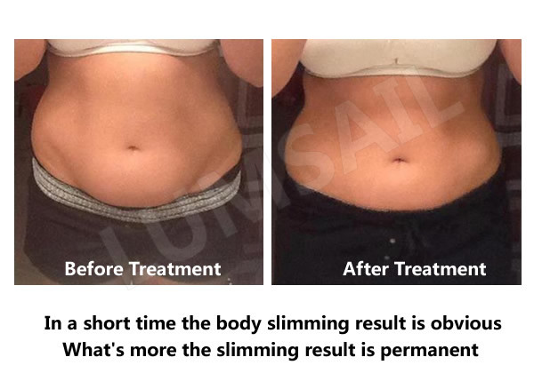 Liposuction Cryolipolysis Body Slimming Machine , Fat Melting Machine CE Approved