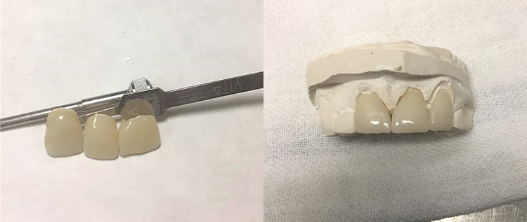B1 B2 Colours SHT Zirconia Multilayer Block For Veneers Teeth