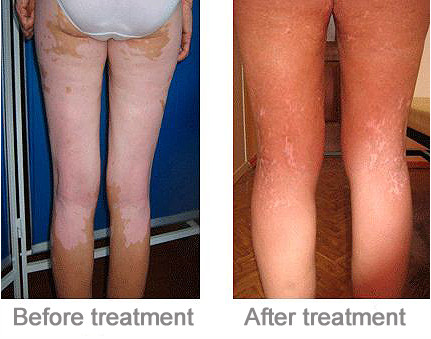 Phillip Uvb Lamp Comb Uv Light Therapy For Psoriasis / Vitiligo Treatment