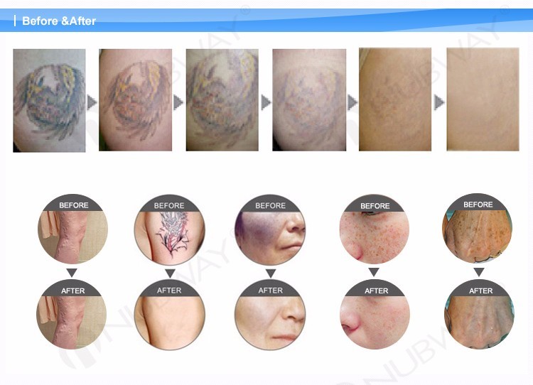 Professional medical tattoo removal laser 1064nm & 532nm Q switch nd yag laser parts