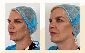 Endolift Laser For Hips Say Goodbye To Under Eye Bags And Achieve Youthful Results