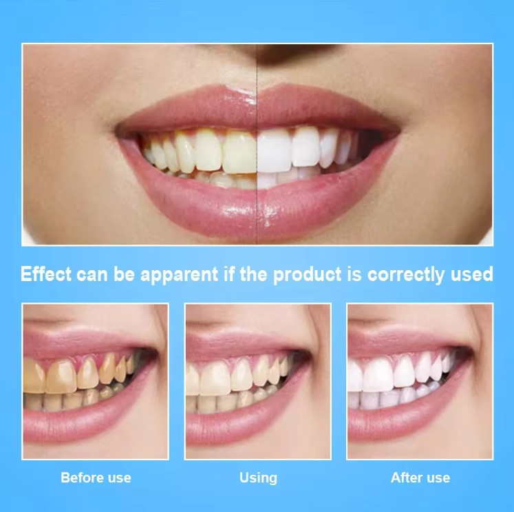 Home Use Led Light Teeth Bleaching  Improve Tooth Yellowing Tooth Whiter Tool