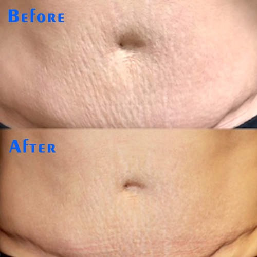 maggie RF Microneedling Machine Skin Treatment 2-4mhz