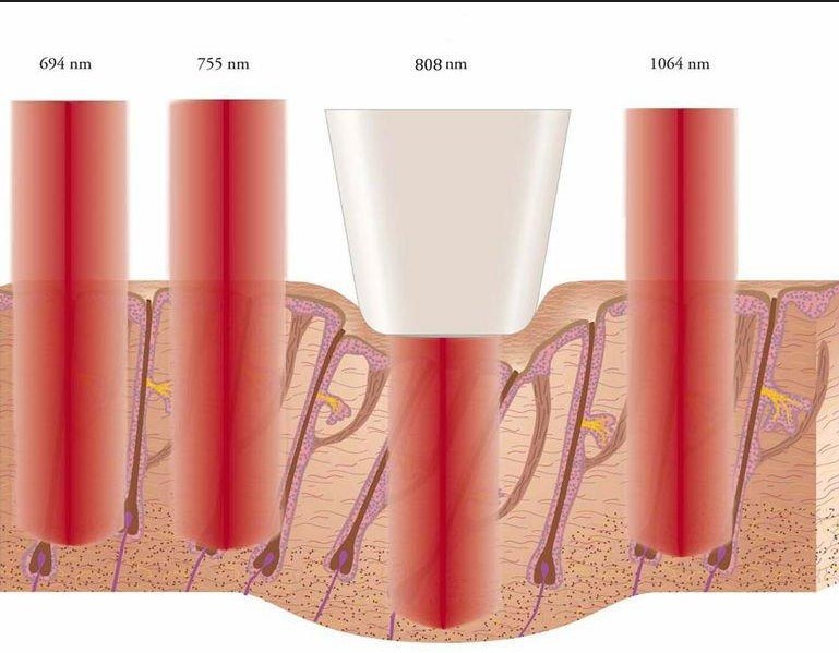 Different Area Treat Diode Laser Hair Removal Machine Male Facial Hair Removal