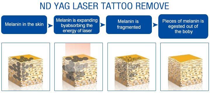3000w picolaser Tattoo Removal Machine 500-800ps Hydro Dermabrasion