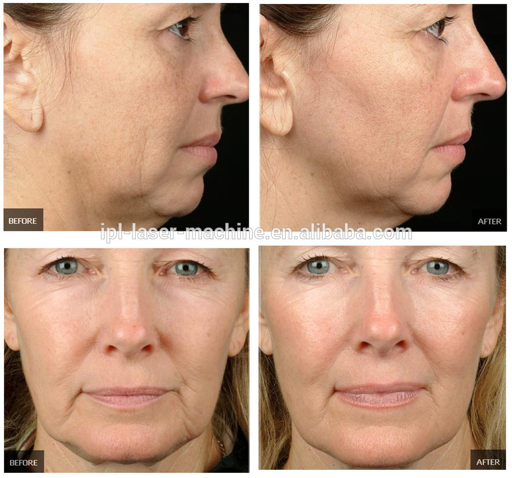 2014 newest Professional rf facial machine5.jpg