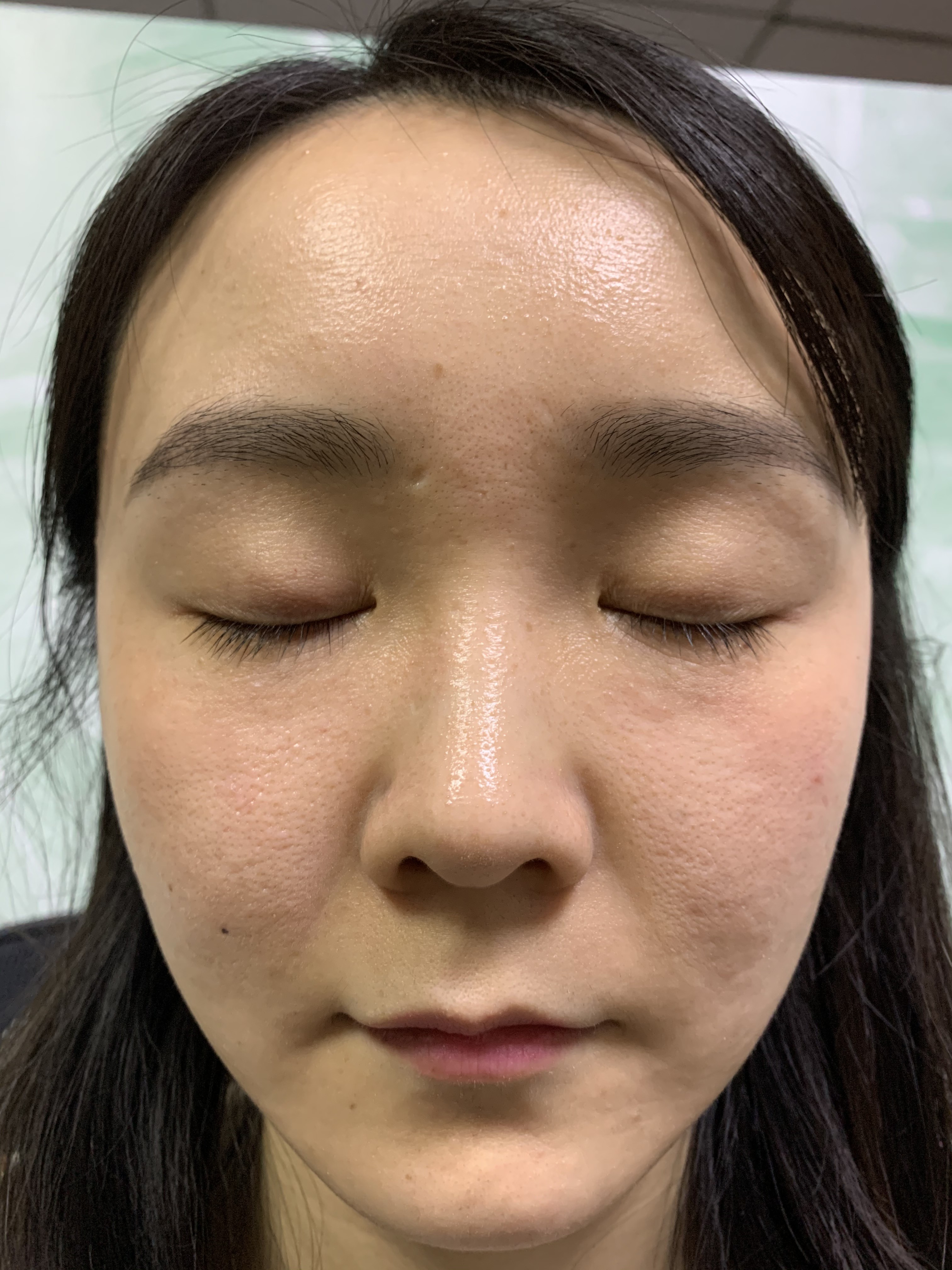 15kg RF Microneedling Machine Skin Tightening Dual operation mode