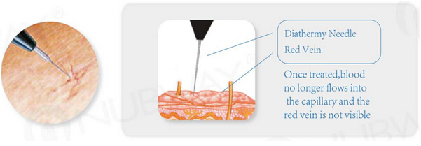 Immediately result spider vein removal varicose veins treatment machine / vascular surgical instruments
