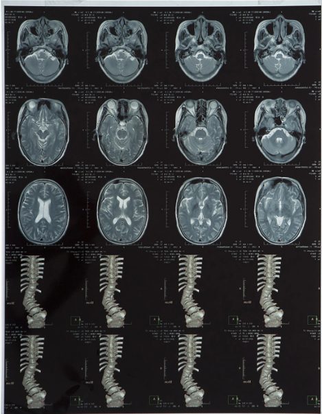 High-clarity Medical X Ray Film FUJI DIHT 14*17in Laser Dry Imaging Film