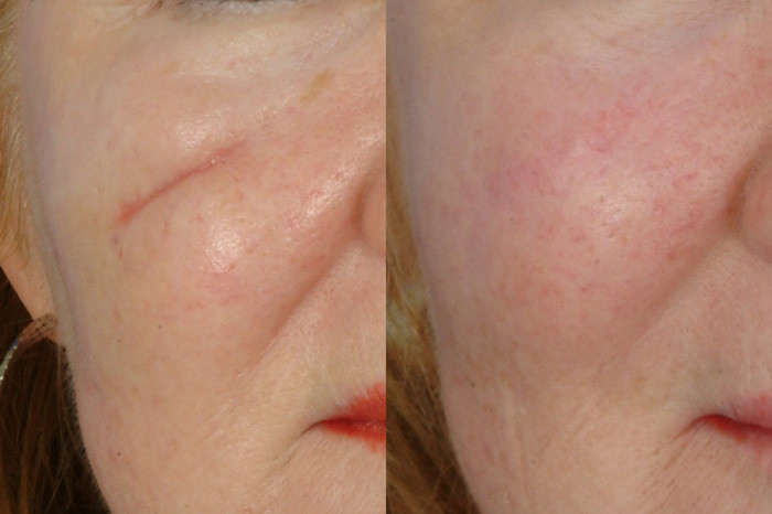 Safety CO2 Acne Scar Removal Machine , Carbon Dioxide Laser Resurfacing Machine