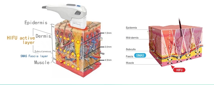 Professional 3d hifu face lifting machine/11 lines 3d hifu/ wrinkle removal hifu machine
