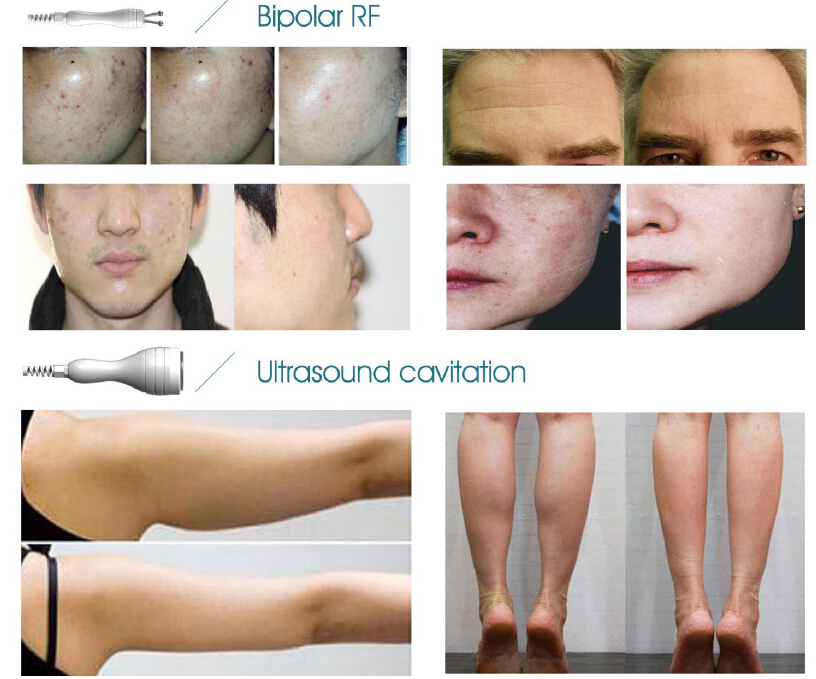 *New product looking for distributor! Hifu slimming machine