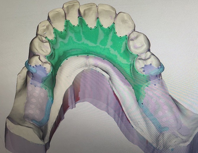 CAD Digital Impression Of Oral Scanning STL Files